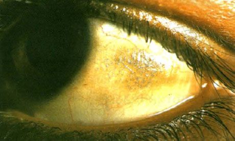 Xerophthalmia.  Biton plakit näyttävät kohonneilta, useiden asteikkojen laskeumalla, sidekalvon sivuilla, jotka sijaitsevat silmäluomien ulkopuolella.  Kuten tässäkin tapauksessa patologiset alueet ovat usein pigmentoituneita.