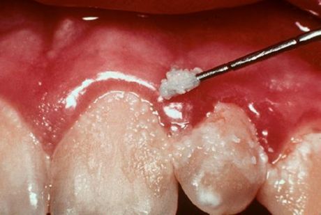 Hampaat ja ientulehdus