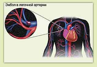 Keuhkoembolia ja rintakipu vasemmalla